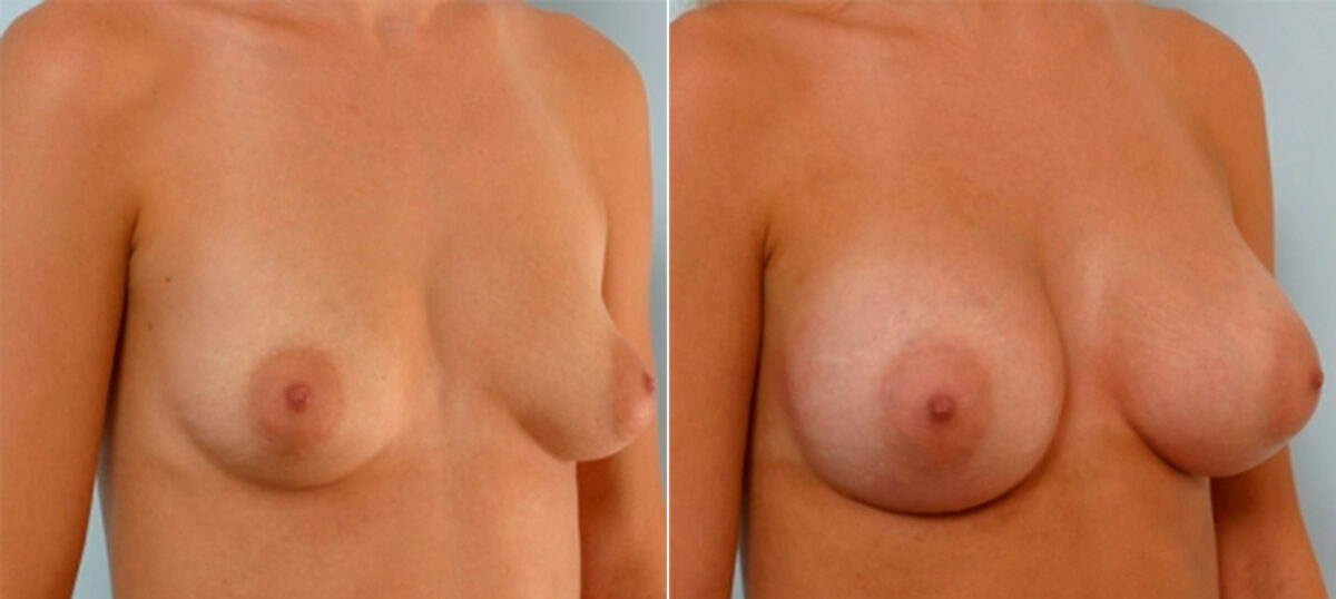 Breast Augmentation before and after photos in Houston, TX, Patient 25316