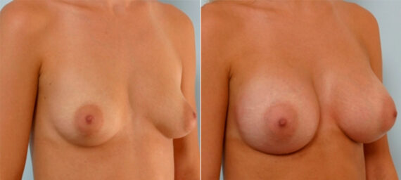 Breast Augmentation before and after photos in Houston, TX, Patient 25316