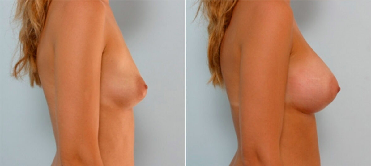 Breast Augmentation before and after photos in Houston, TX, Patient 25316