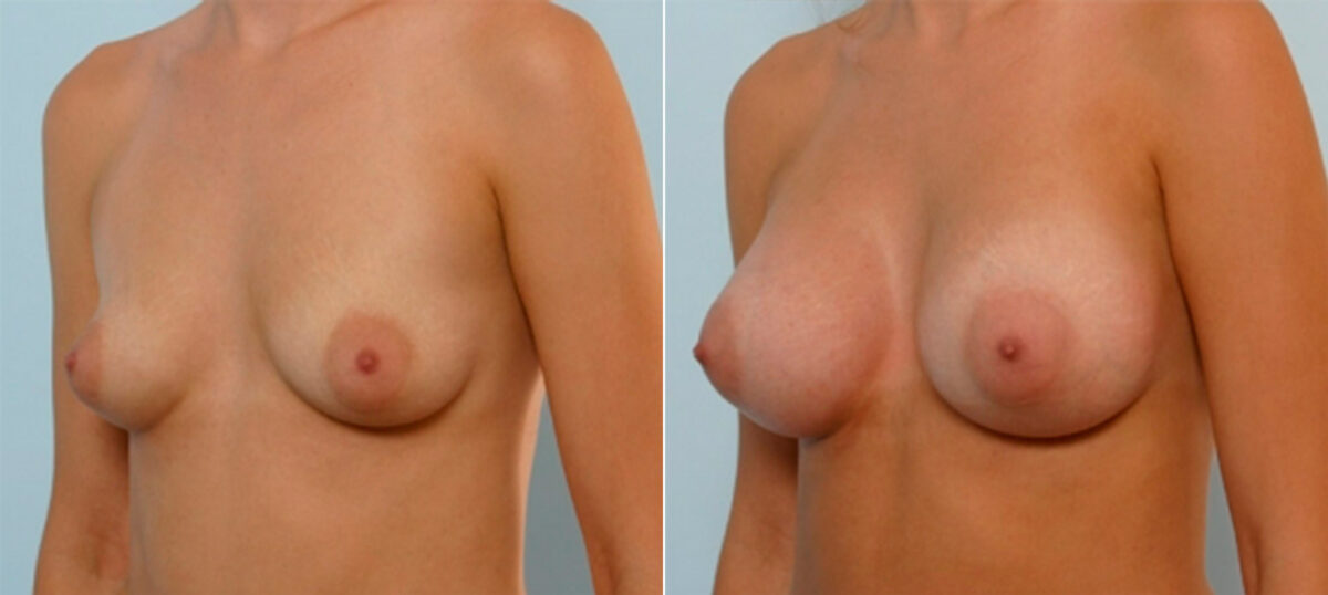 Breast Augmentation before and after photos in Houston, TX, Patient 25316