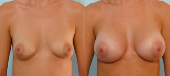 Breast Augmentation before and after photos in Houston, TX, Patient 25316