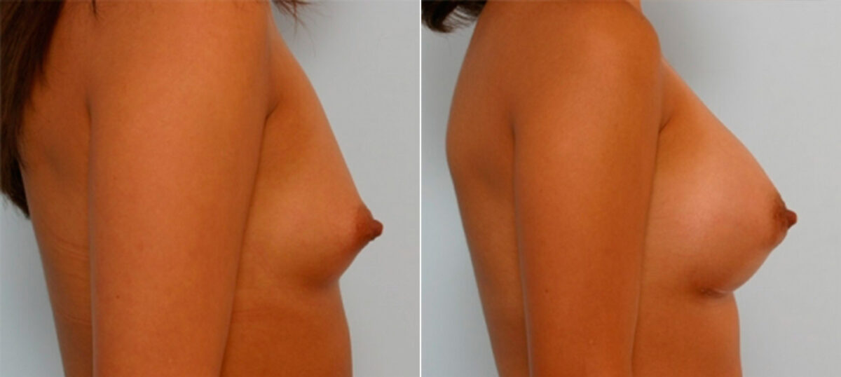 Breast Augmentation before and after photos in Houston, TX, Patient 25327