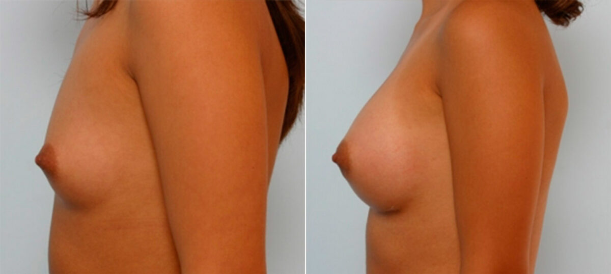 Breast Augmentation before and after photos in Houston, TX, Patient 25327
