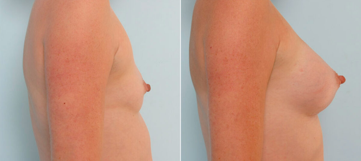 Breast Augmentation before and after photos in Houston, TX, Patient 25338