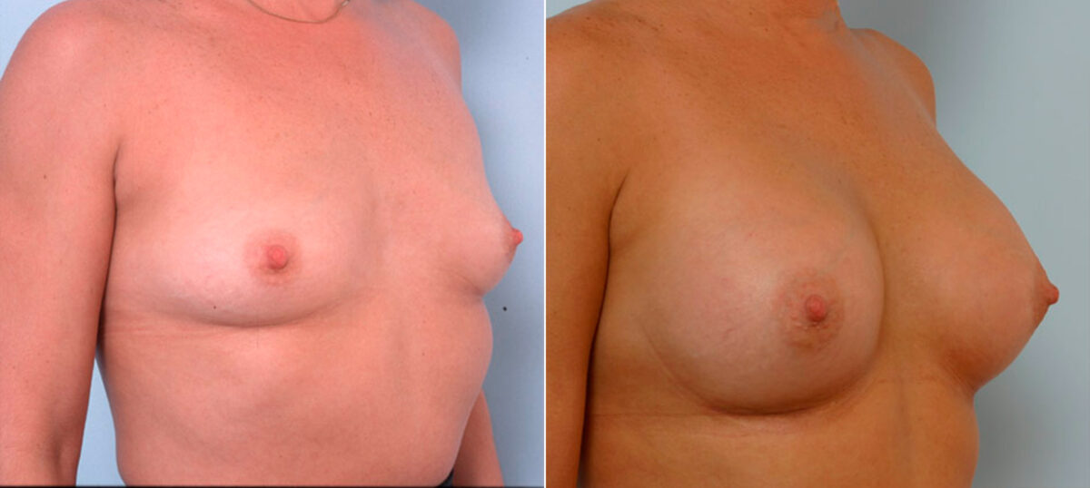 Breast Augmentation before and after photos in Houston, TX, Patient 25347