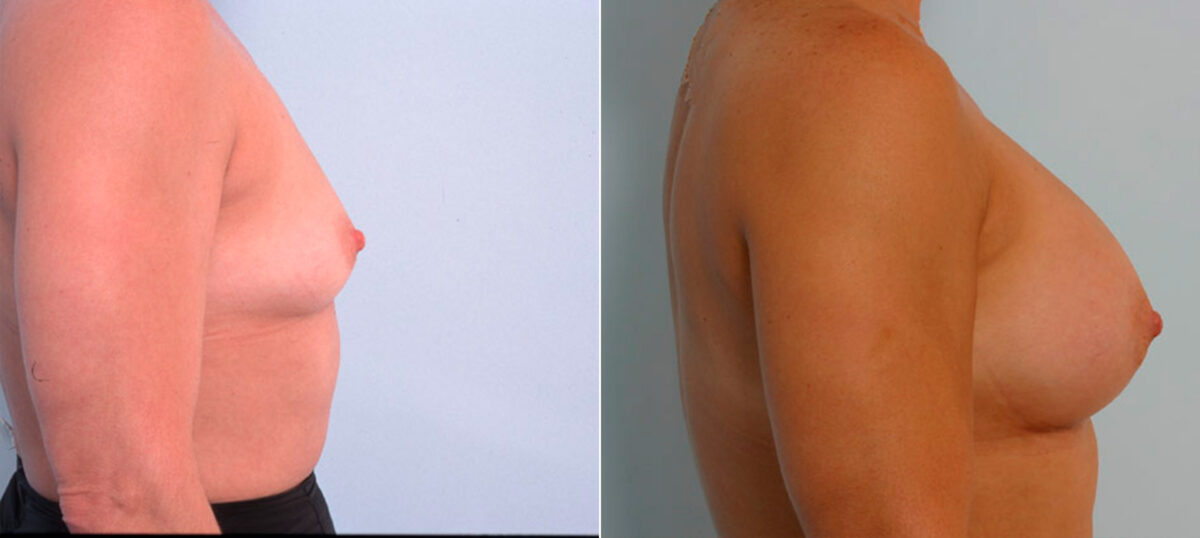 Breast Augmentation before and after photos in Houston, TX, Patient 25347