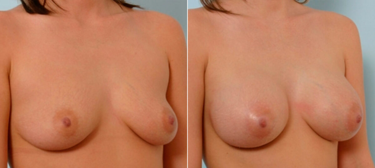 Breast Augmentation before and after photos in Houston, TX, Patient 25352