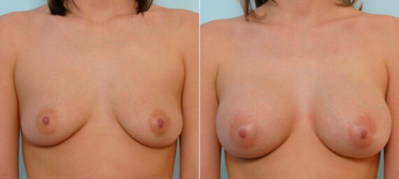Breast Augmentation before and after photos in Houston, TX, Patient 25352