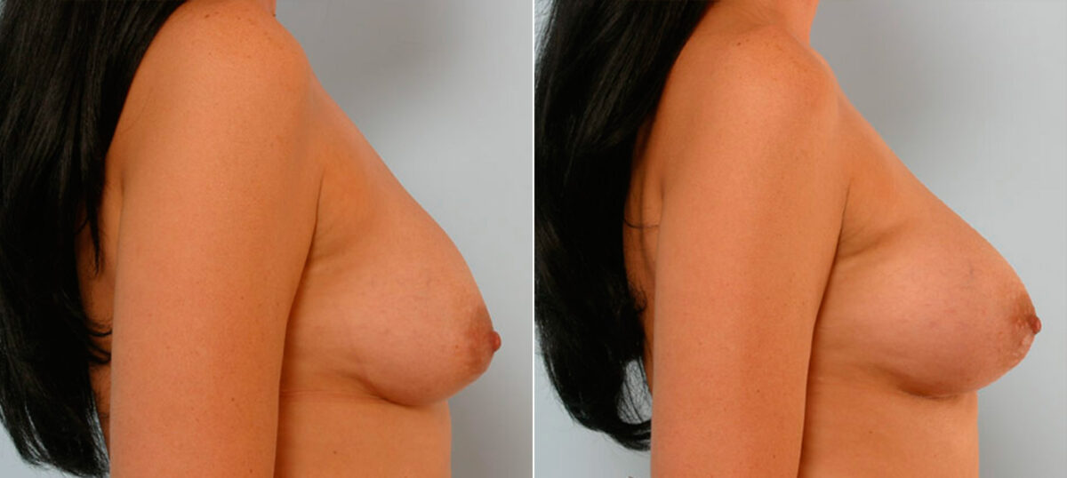 Breast Augmentation before and after photos in Houston, TX, Patient 25359