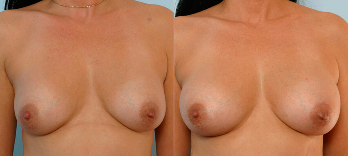 Breast Augmentation before and after photos in Houston, TX, Patient 25359