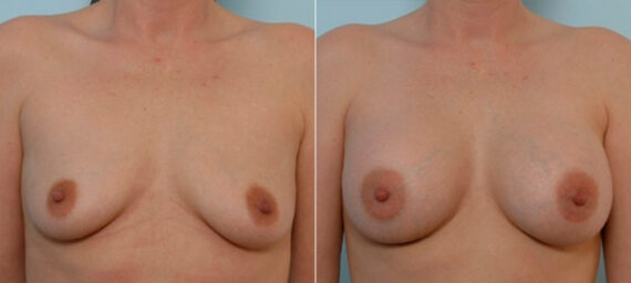 Breast Augmentation before and after photos in Houston, TX, Patient 25366