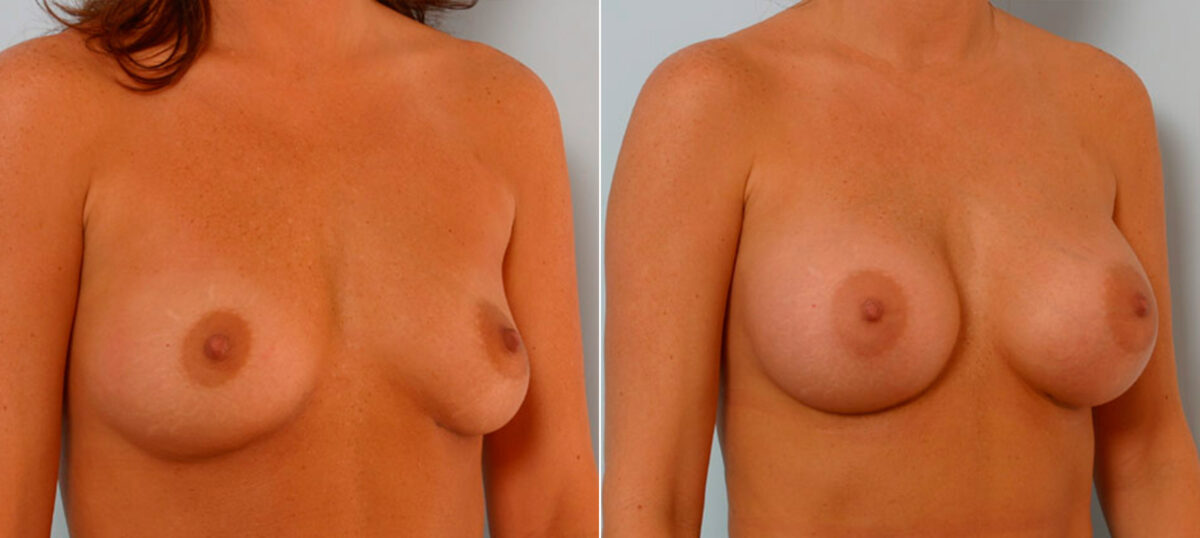 Breast Augmentation before and after photos in Houston, TX, Patient 25378