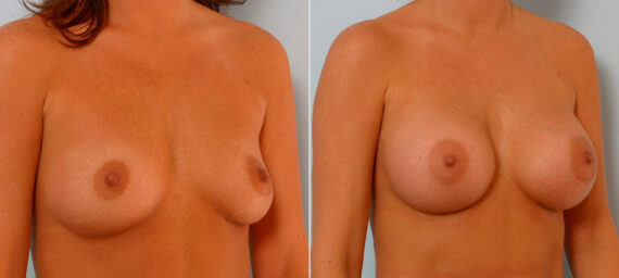 Breast Augmentation before and after photos in Houston, TX, Patient 25378