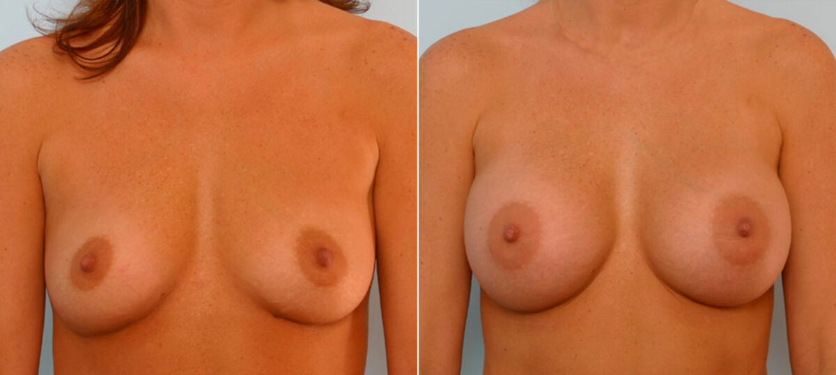 Breast Augmentation before and after photos in Houston, TX, Patient 25378
