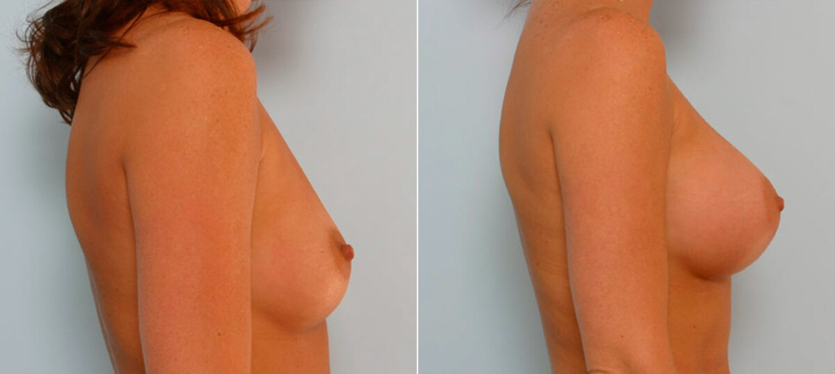 Breast Augmentation before and after photos in Houston, TX, Patient 25378