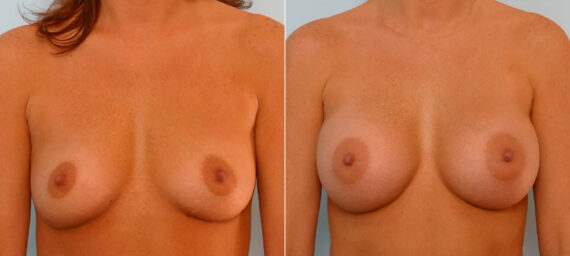 Breast Augmentation before and after photos in Houston, TX, Patient 25378