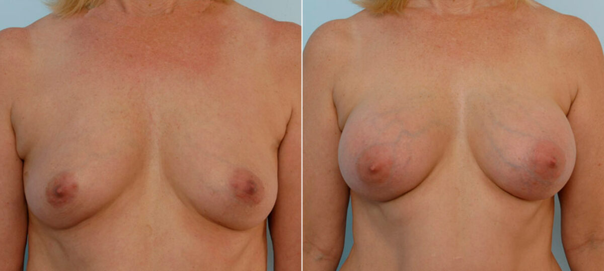 Breast Augmentation before and after photos in Houston, TX, Patient 25385