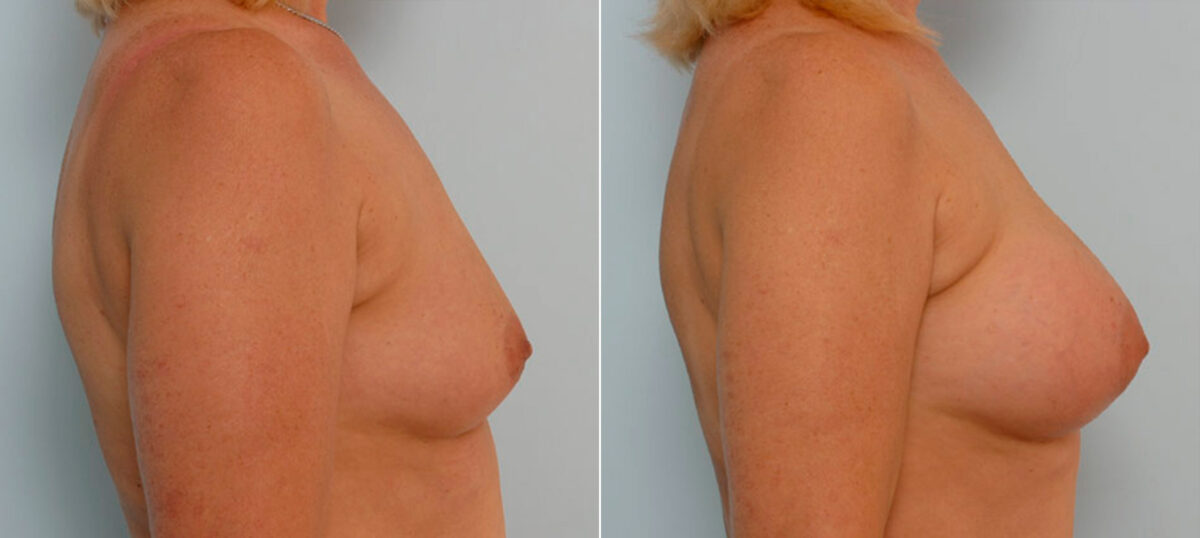 Breast Augmentation before and after photos in Houston, TX, Patient 25385