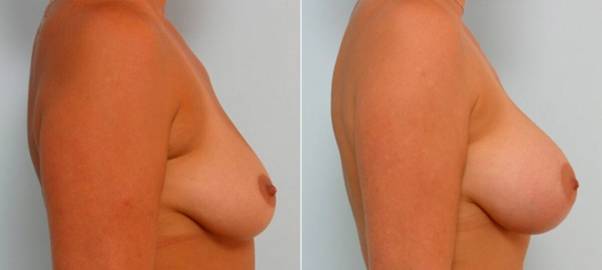 Breast Augmentation before and after photos in Houston, TX, Patient 25392