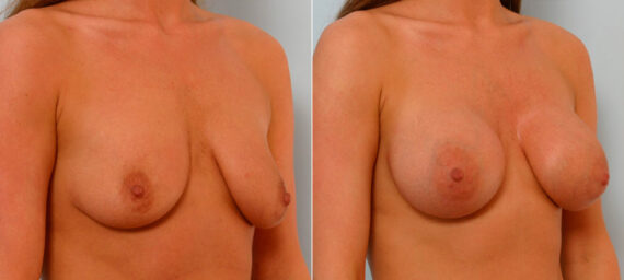 Breast Augmentation before and after photos in Houston, TX, Patient 25399