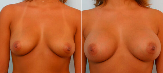 Breast Augmentation before and after photos in Houston, TX, Patient 25406