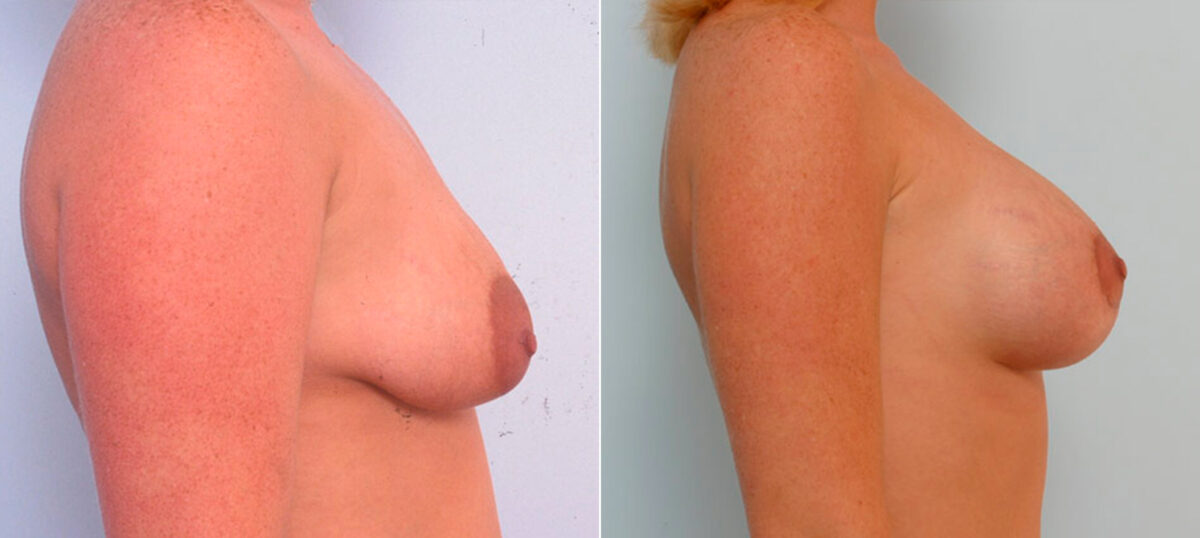 Breast Augmentation before and after photos in Houston, TX, Patient 25413
