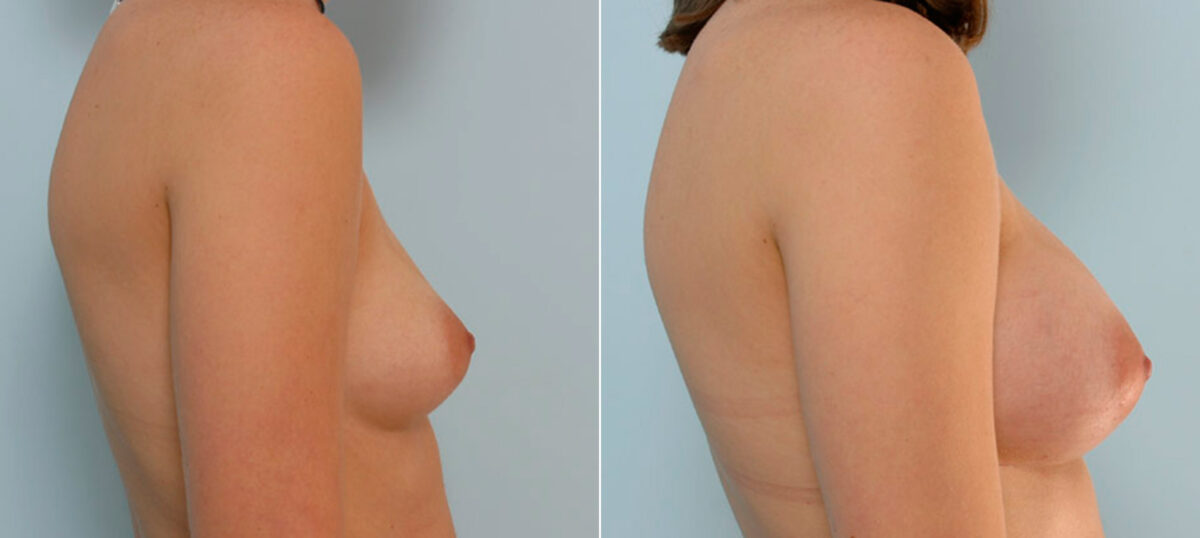 Breast Augmentation before and after photos in Houston, TX, Patient 25420
