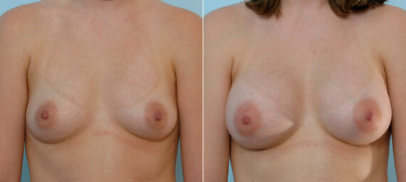 Breast Augmentation before and after photos in Houston, TX, Patient 25420