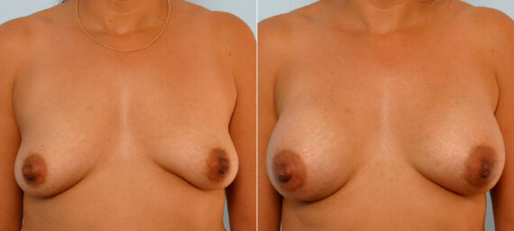 Breast Augmentation before and after photos in Houston, TX, Patient 25427
