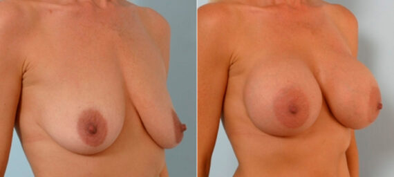 Breast Augmentation before and after photos in Houston, TX, Patient 25441