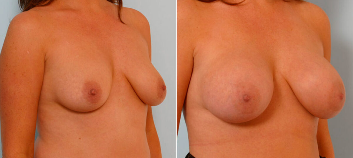 Breast Augmentation before and after photos in Houston, TX, Patient 25446
