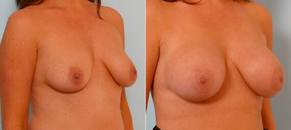 Breast Augmentation before and after photos in Houston, TX, Patient 25446