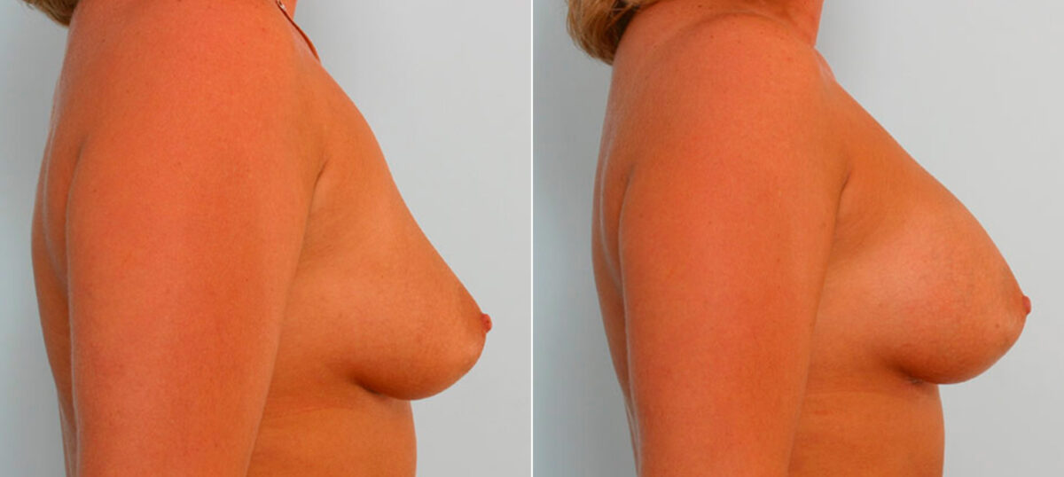 Breast Augmentation before and after photos in Houston, TX, Patient 25453