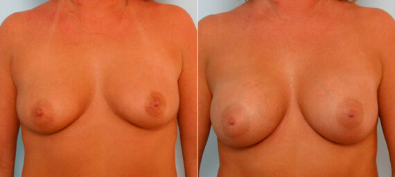 Breast Augmentation before and after photos in Houston, TX, Patient 25453