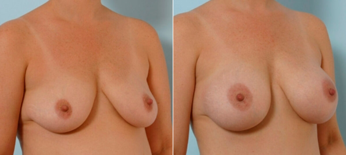 Breast Augmentation before and after photos in Houston, TX, Patient 25460