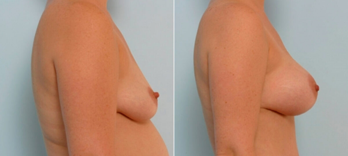 Breast Augmentation before and after photos in Houston, TX, Patient 25460