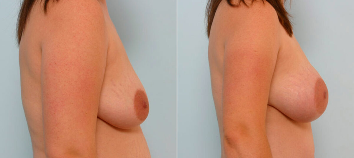 Breast Augmentation before and after photos in Houston, TX, Patient 25467