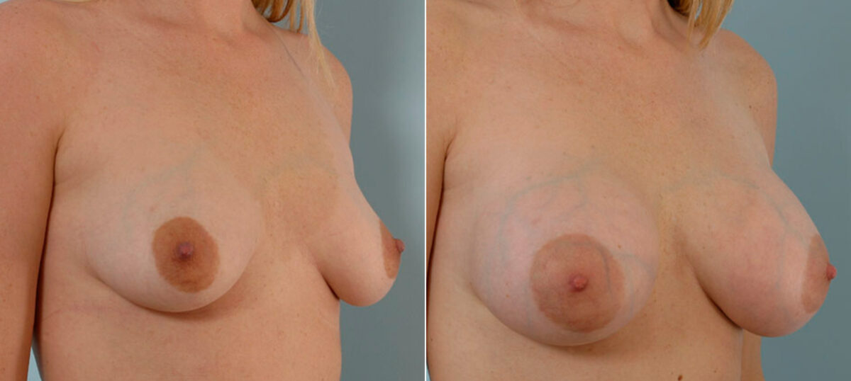 Breast Augmentation before and after photos in Houston, TX, Patient 25474