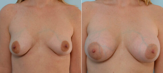 Breast Augmentation before and after photos in Houston, TX, Patient 25474