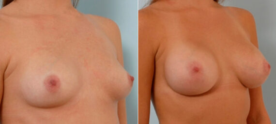 Breast Augmentation before and after photos in Houston, TX, Patient 25488