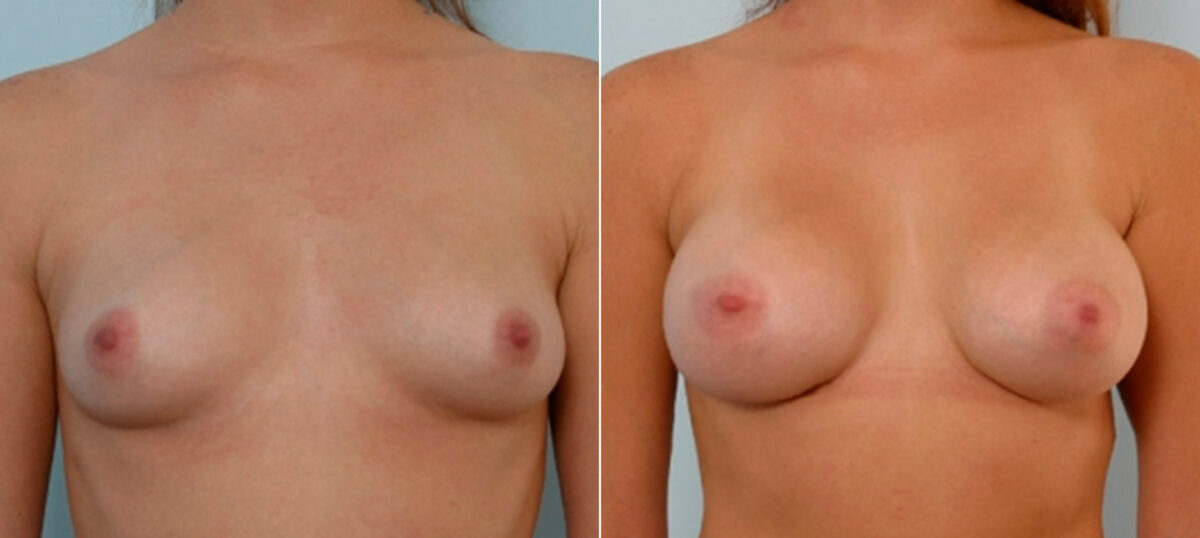 Breast Augmentation before and after photos in Houston, TX, Patient 25488
