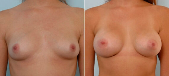Breast Augmentation before and after photos in Houston, TX, Patient 25488
