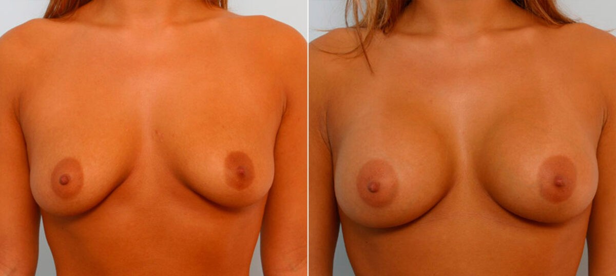 Patient 25495, Breast Augmentation before and after photos Breast Augmentation before and after photos in Houston, TX, Patient 25495