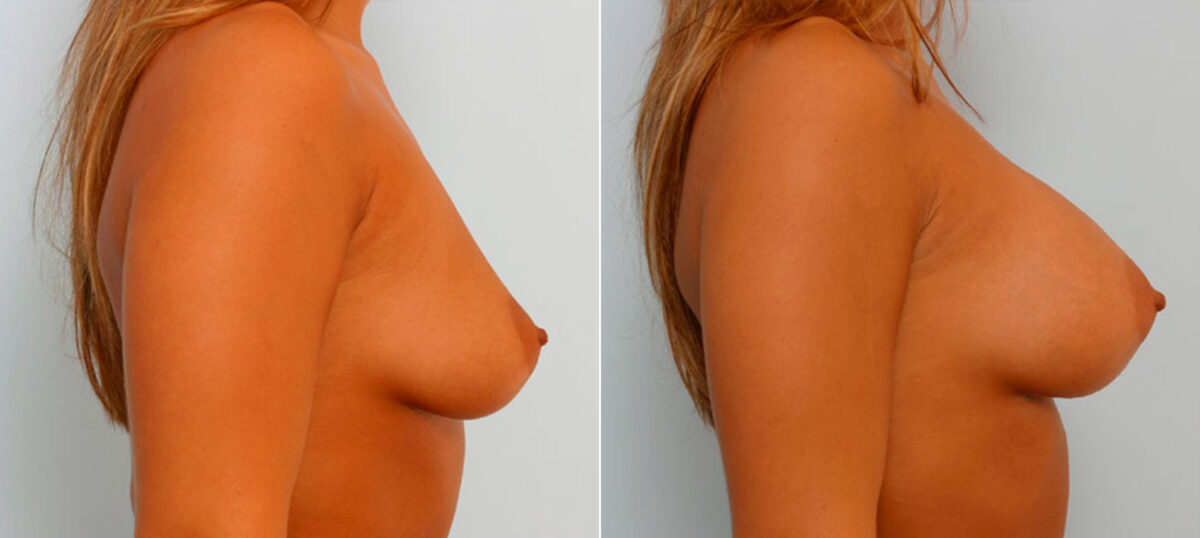 Breast Augmentation before and after photos in Houston, TX, Patient 25495