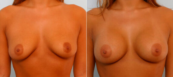Breast Augmentation before and after photos in Houston, TX, Patient 25495