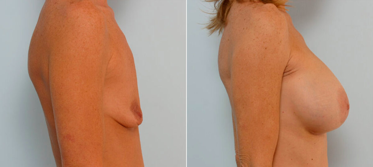 Breast Augmentation before and after photos in Houston, TX, Patient 25502