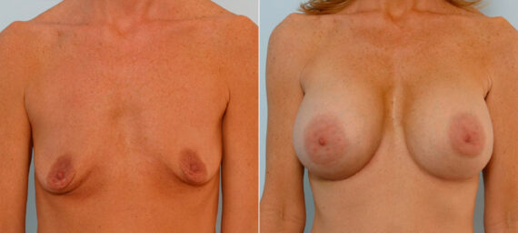 Breast Augmentation before and after photos in Houston, TX, Patient 25502