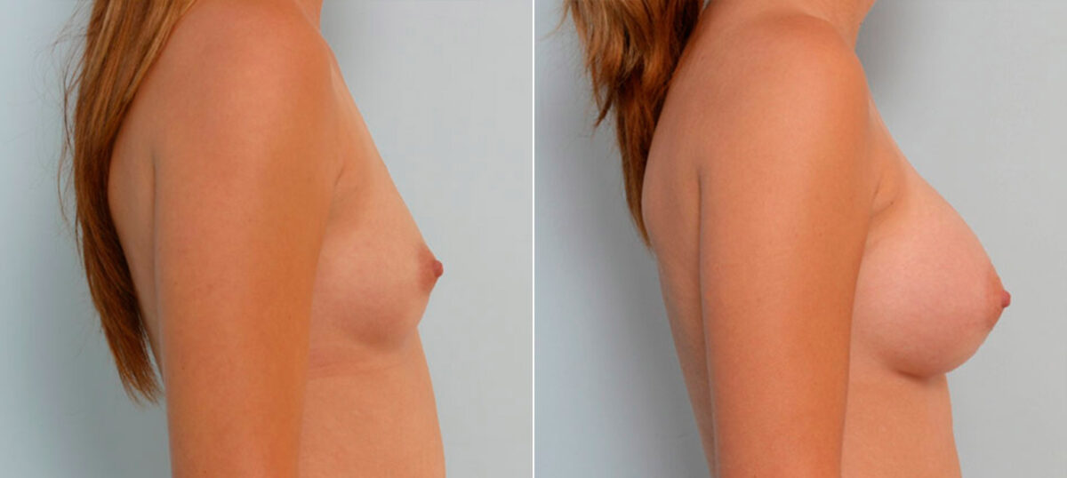 Breast Augmentation before and after photos in Houston, TX, Patient 25509