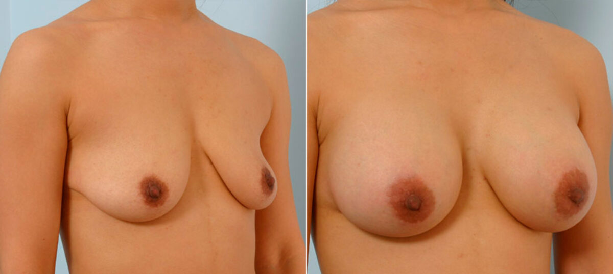 Breast Augmentation before and after photos in Houston, TX, Patient 25516