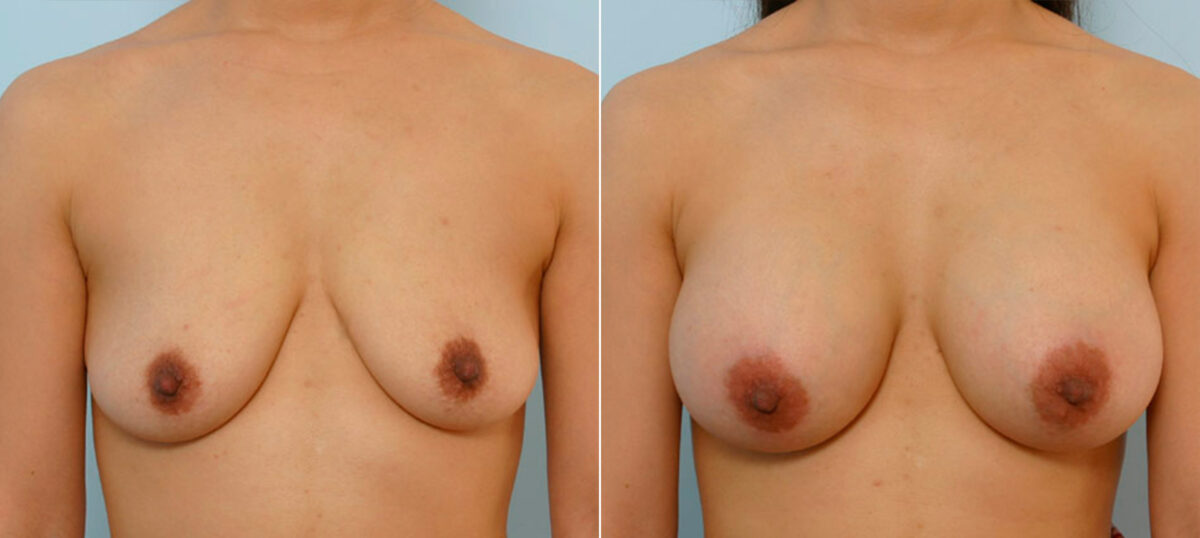 Breast Augmentation before and after photos in Houston, TX, Patient 25516